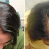 brava spa hair loss treatment