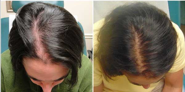 Brava spa hair loss treatment