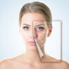 Acne treatment